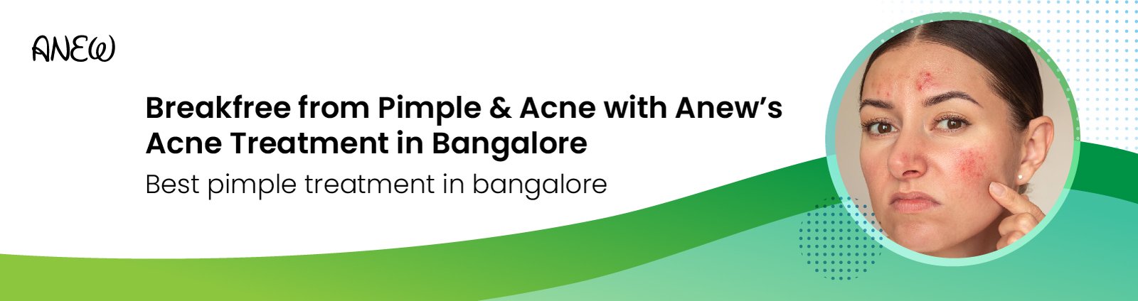 acne treatment in bangalore​